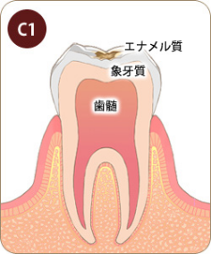 エナメル質の部分がむし歯になっている